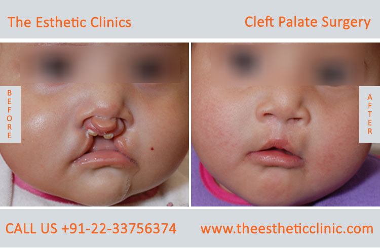 cleft palate surgery, Cleft Palate Repair Treatment before after photos in mumbai india (5)
